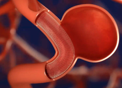 フローダイバーターイメージ