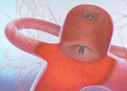 脳血管内治療 | 福岡市城南区「中村脳神経外科」頭痛・物忘れ・てんかん等